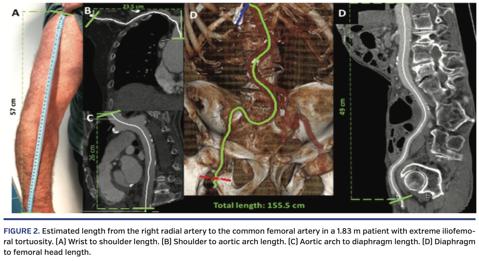 Transradial Crossover Balloon Occlusion Technique for Primary Access
